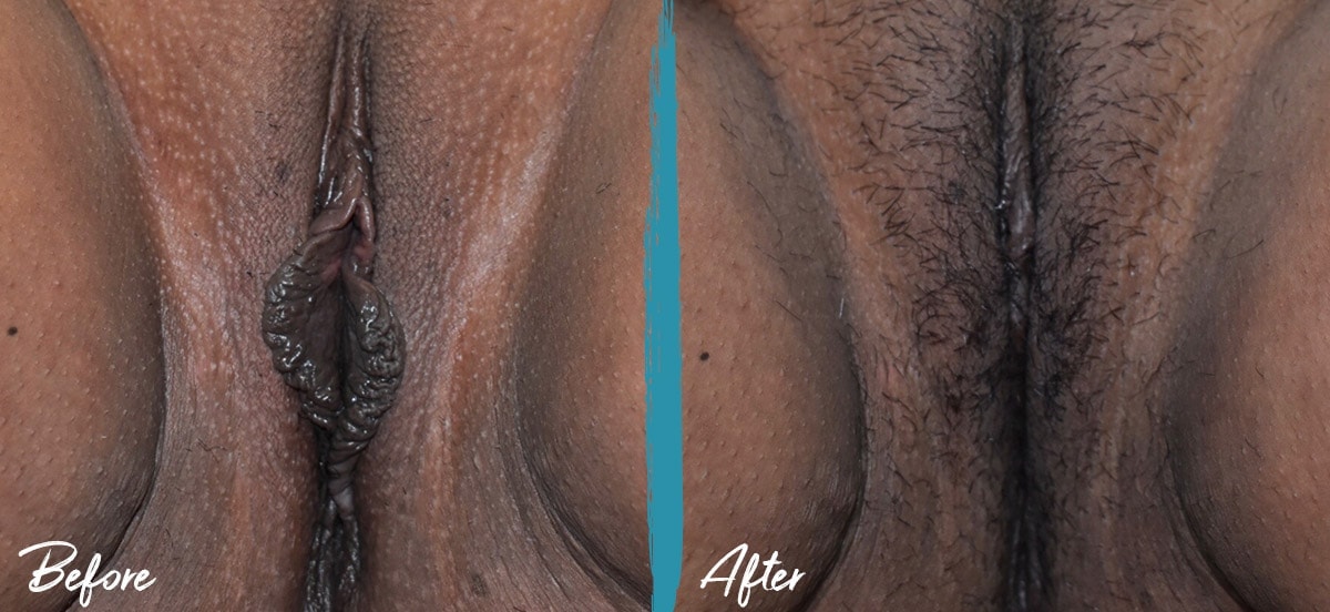Anal Bleaching Before And After Pics