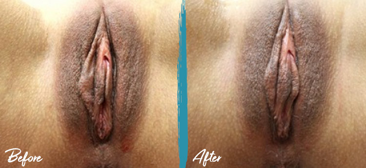 thermiva vaginal rejuvenation before and after photo 1