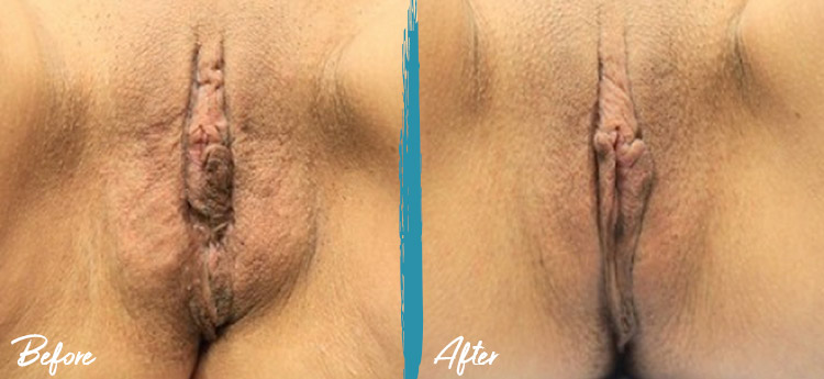 thermiva vaginal rejuvenation before and after photo 2
