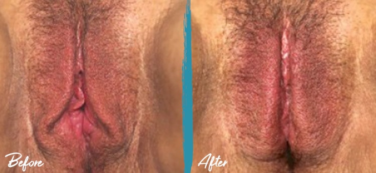 thermiva vaginal rejuvenation before and after photo 3