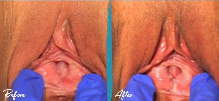 thermiva rejuvenecimiento vaginal antes y despues foto 6