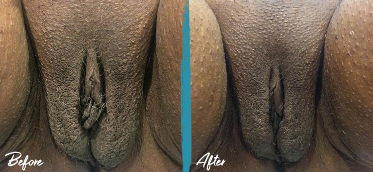 thermiva vaginal rejuvenation before and after photo 8