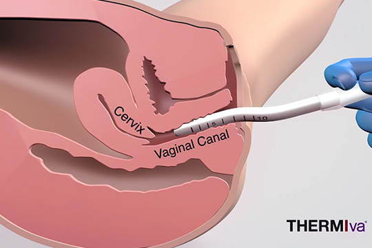 Thermiva Vaginal Rejuvenation