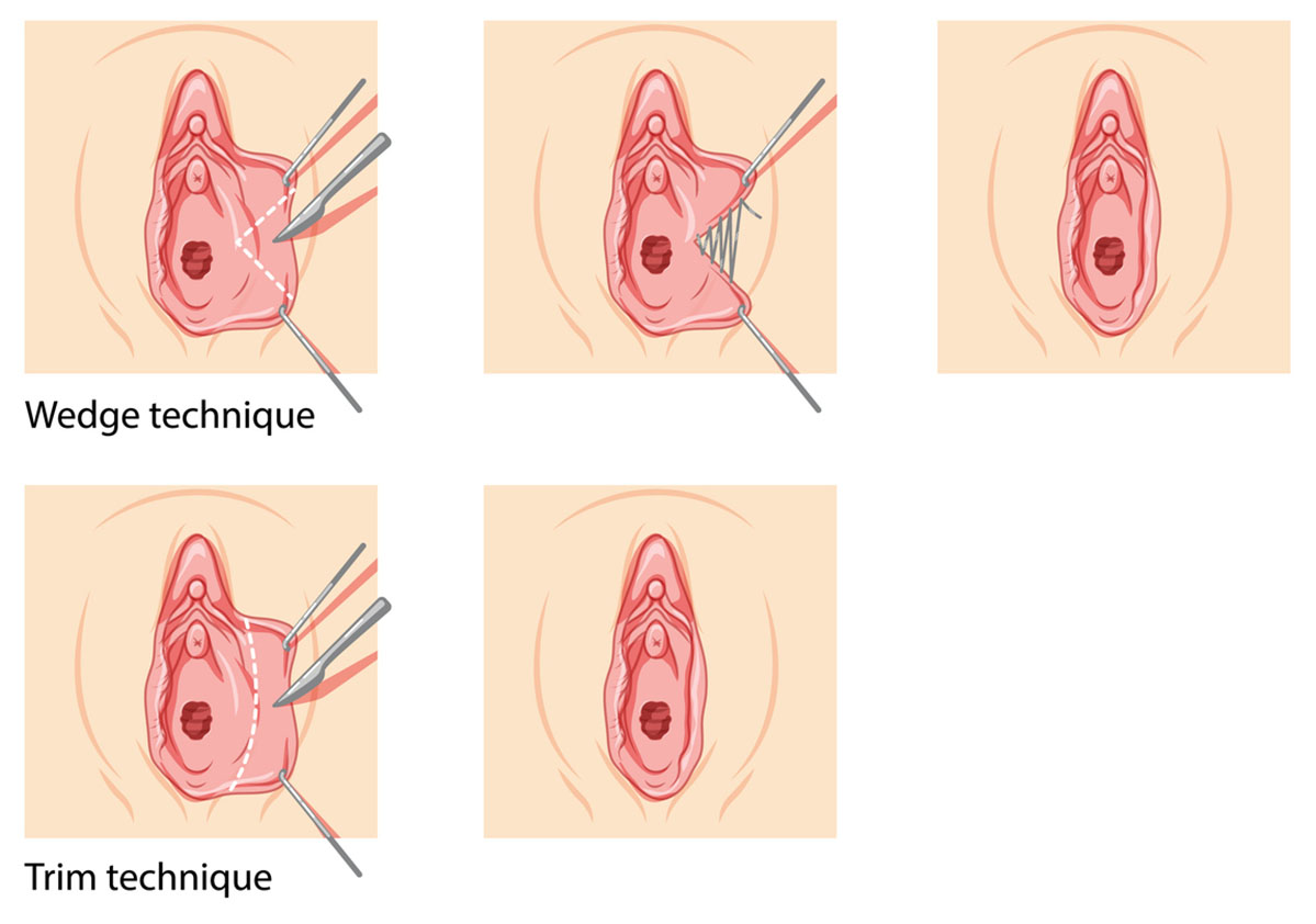 What to expect when recovering from a labiaplasty