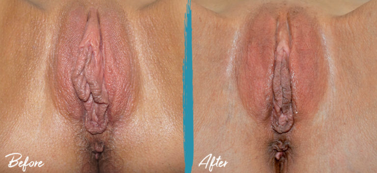 Reducción del capuchón del clítoris y labioplastia NYC Foto de antes y después 01