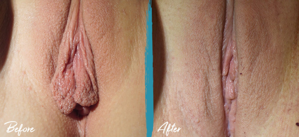 Clitoral Hood Reduction & Labiaplasty NYC Before And After Photo