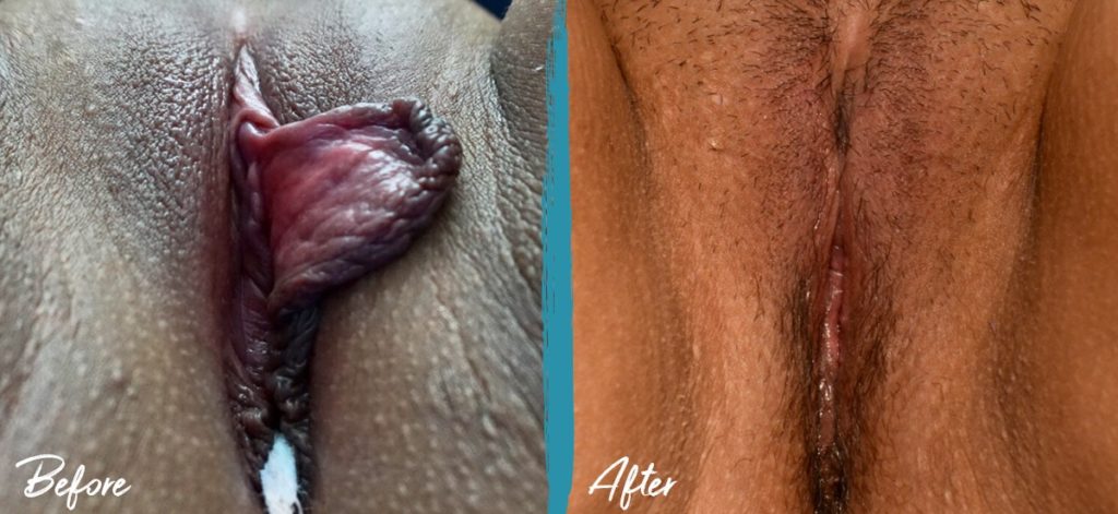 Labiaplasty NYC Before And After Photo 06