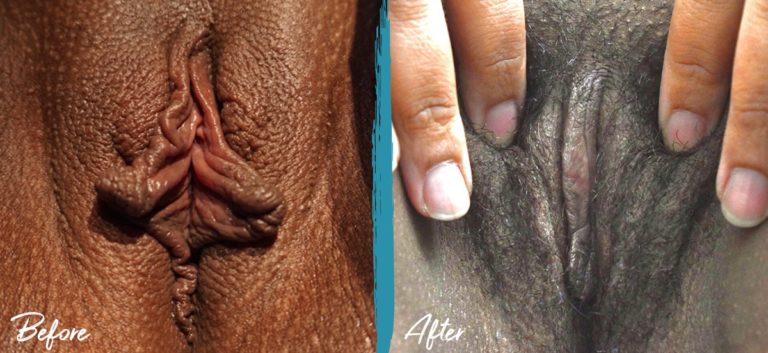 Labiaplasty NYC Before And After Photo 07