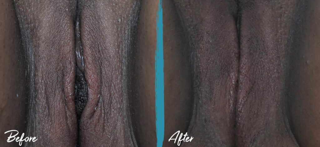 Labiaplasty NYC Before And After Photo