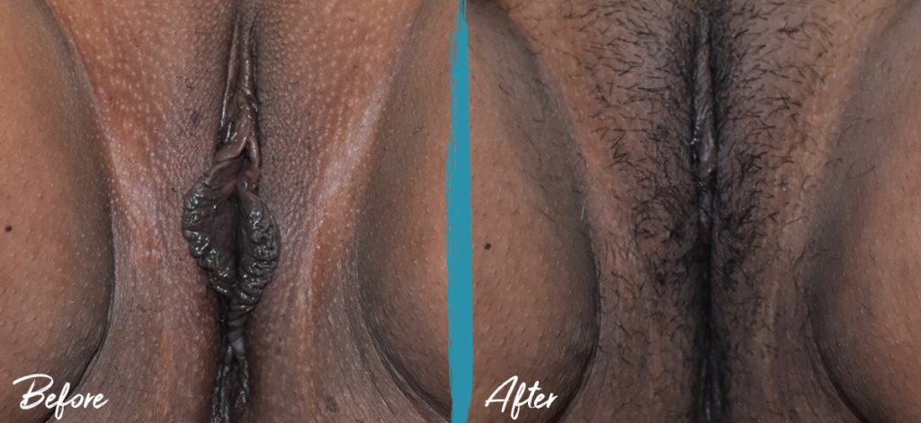Labiaplasty & Clitoral Hood Reduction NYC Before And After Photo 02