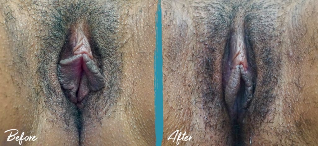 Labiaplasty & Clitoral Hood Reduction NYC Before And After Photo 04