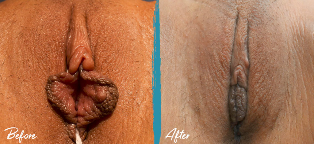Labiaplasty, Clitoral Hood Reduction & Vulvar Fat Graft NYC Before And After Photo 08