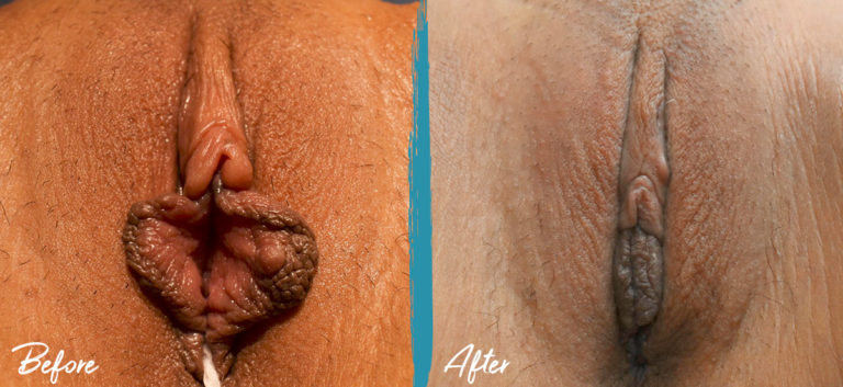 Foto de antes y después de labioplastia, reducción del capuchón del clítoris e injerto de grasa vulvar NYC 08