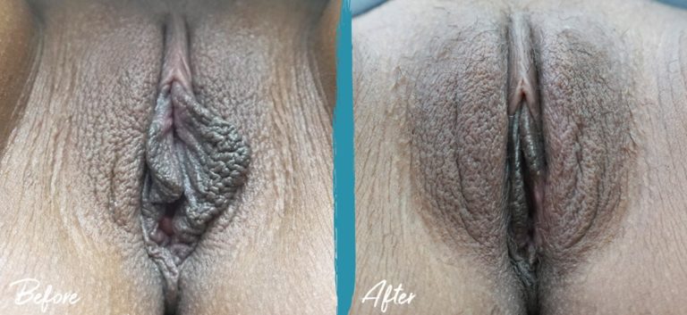 Labioplastia y reducción del capuchón del clítoris NYC Foto de antes y después