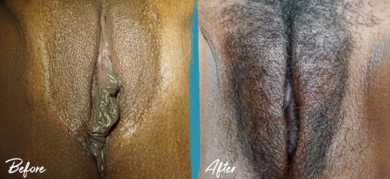 Foto de antes y después de labioplastia, reducción del capuchón del clítoris, perineoplastia e injerto de grasa vulvar