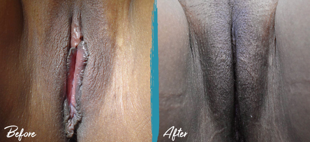 Labiaplasty, Clitoral Hood Reduction & Vulvar Fat Graft NYC Before And After Photo 02