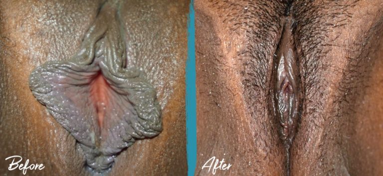 Foto de antes y después de labioplastia, reducción del capuchón del clítoris e injerto de grasa vulvar NYC 03