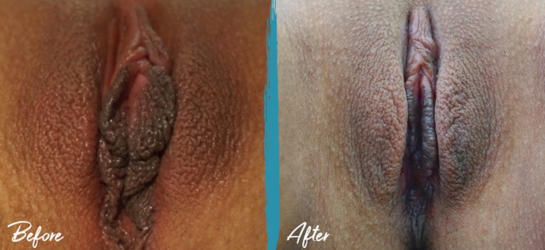 Foto de antes y después de labioplastia, reducción del capuchón del clítoris e injerto de grasa vulvar NYC 04