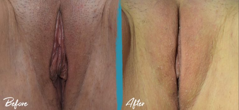 Foto de antes y después de labioplastia, reducción del capuchón del clítoris e injerto de grasa vulvar NYC 05
