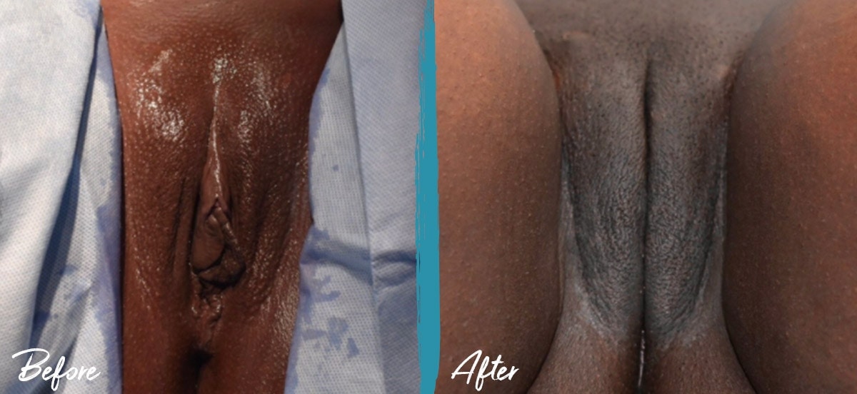 Foto de antes y después de labioplastia, reducción del capuchón del clítoris e injerto de grasa vulvar NYC 08