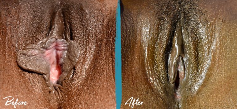Foto de antes y después de labioplastia y perineoplastia NYC