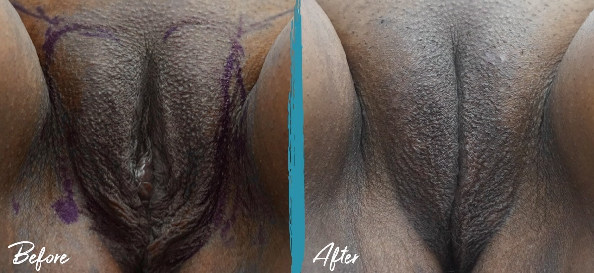 Labioplastia e injerto de grasa vulvar NYC Foto de antes y después