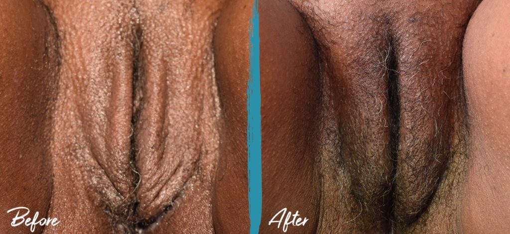 Labiaplasty, Vulvar Fat Graft & Femilift NYC Before And After Photo
