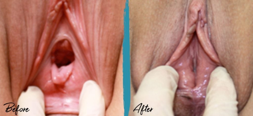 Perineoplasty & Vaginoplasty NYC Before And After Photo