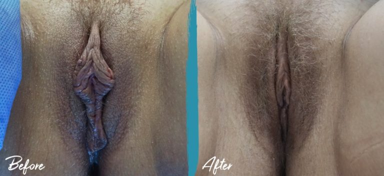 Revisión de labioplastia y reducción del capuchón del clítoris NYC Foto de antes y después 05