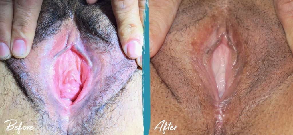Vaginoplasty & Labiaplasty NYC Before And After Photo