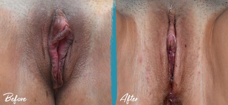 Foto de antes y después de la vaginoplastia, labioplastia y reducción del capuchón del clítoris en NYC