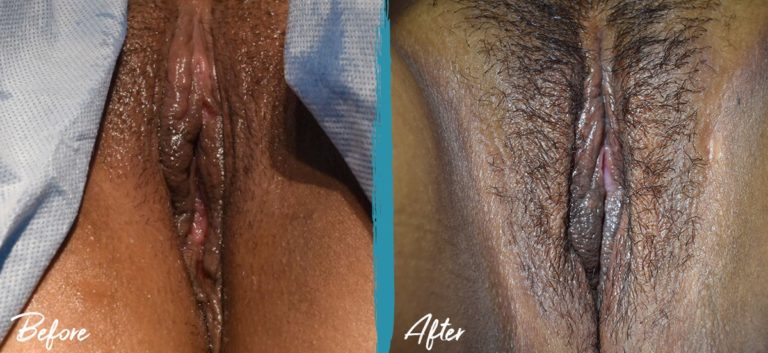 Foto de antes y después de la vaginoplastia y la perineoplastia en NYC