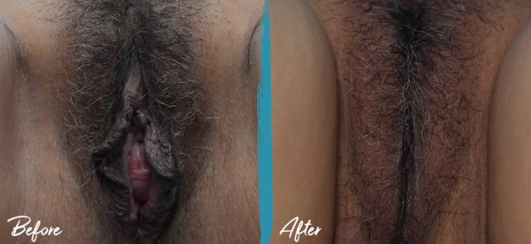 Vaginoplastia, perineoplastia, labioplastia e injerto de grasa vulvar NYC Foto de antes y después