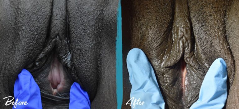 Foto de antes y después de vaginoplastia, perineoplastia y Thermiva NYC