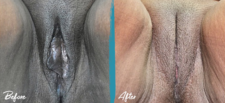 Imagen 2 antes y después - Vaginoplastia, transferencia de grasa a labios vaginales bilateralmente y Labioplastia
