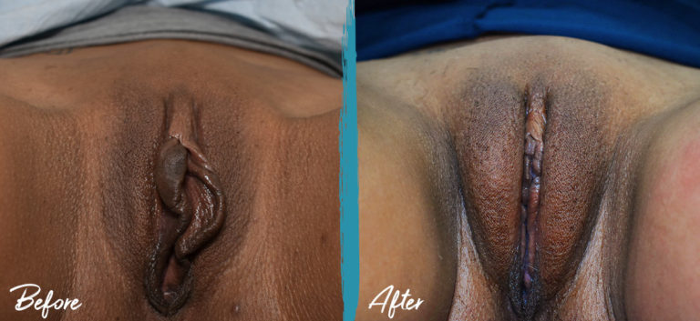 Antes y después - Labioplastia