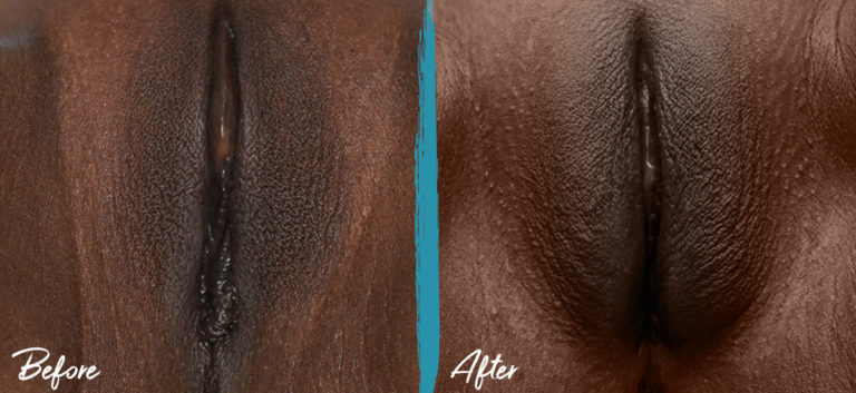 Eliminación de cicatrices perineales, perineoplastia, vaginoplastia e injerto de grasa vulvar NYC Foto de antes y después