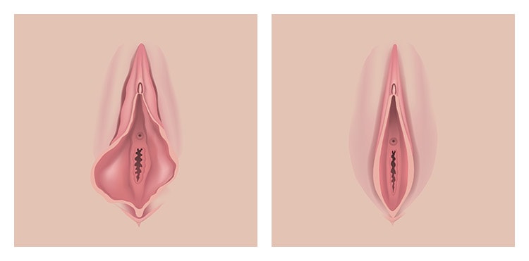 Before and After FemiLift Vaginal Rejuvenation Photos NYC