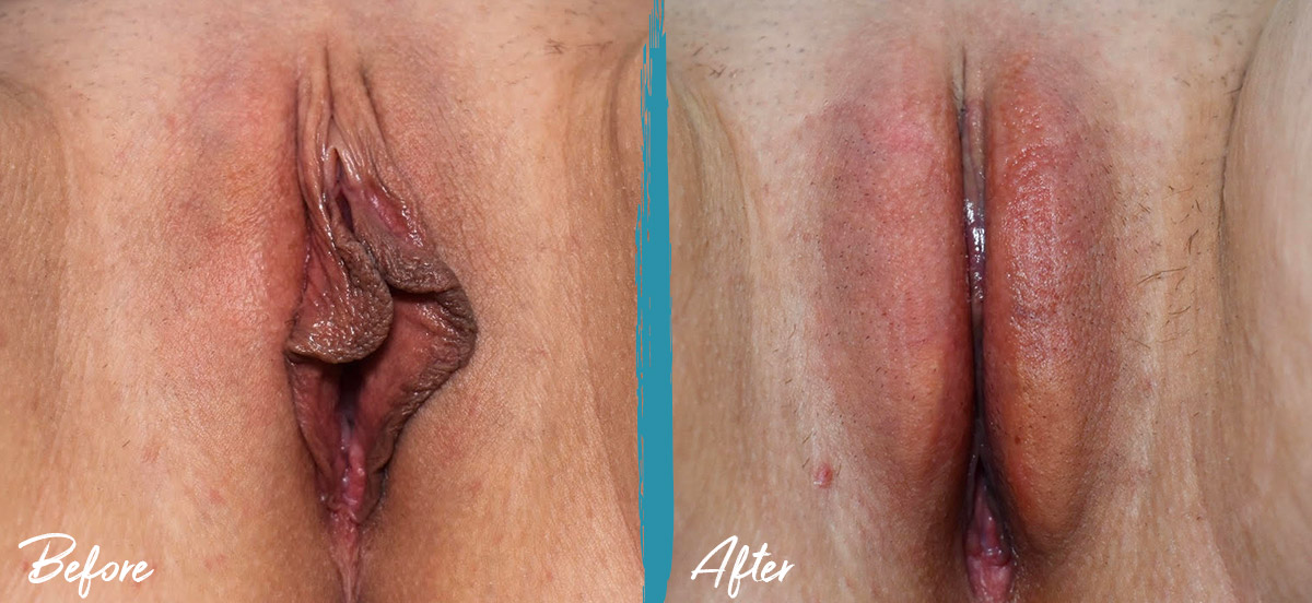 Antes y después de la labioplastia Transferencia de grasa Reducción del capuchón del clítoris NYC 37