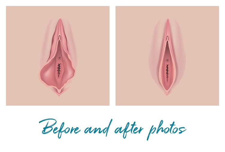 Before and After Labiaplasty Photos