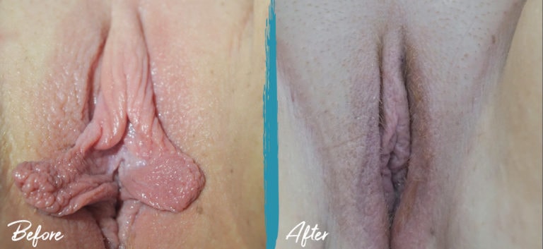 labiaplasty nyc clitoral hood reduction before and after 01