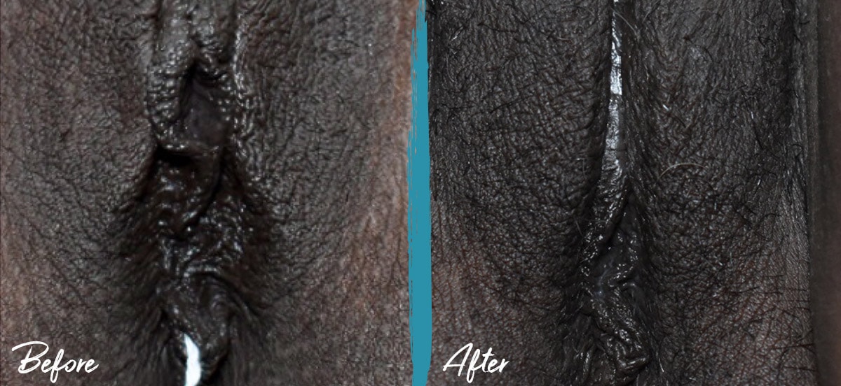 Labioplastia Reducción del capuchón del clítoris y transferencia de grasa antes y después de la foto NYC