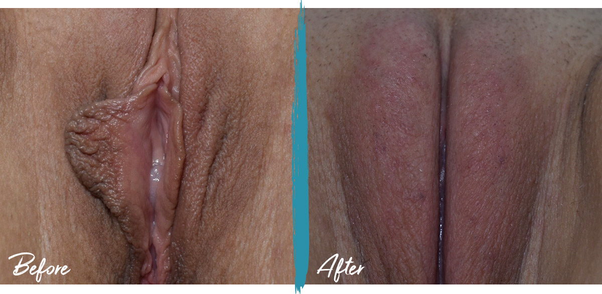 Vaginoplasty, Labiaplasty, Perineoplasty, Clitoral Hood Reduction, Fat Transfer Photo 1