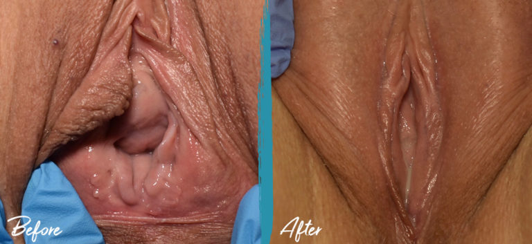 Vaginoplastia, Labioplastia, Perineoplastia, Reducción del capuchón del clítoris, Transferencia de grasa Foto 2