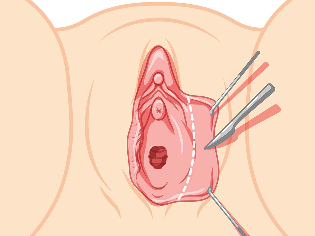 Tipos de técnica de recorte de revisión de labioplastia en Nueva York