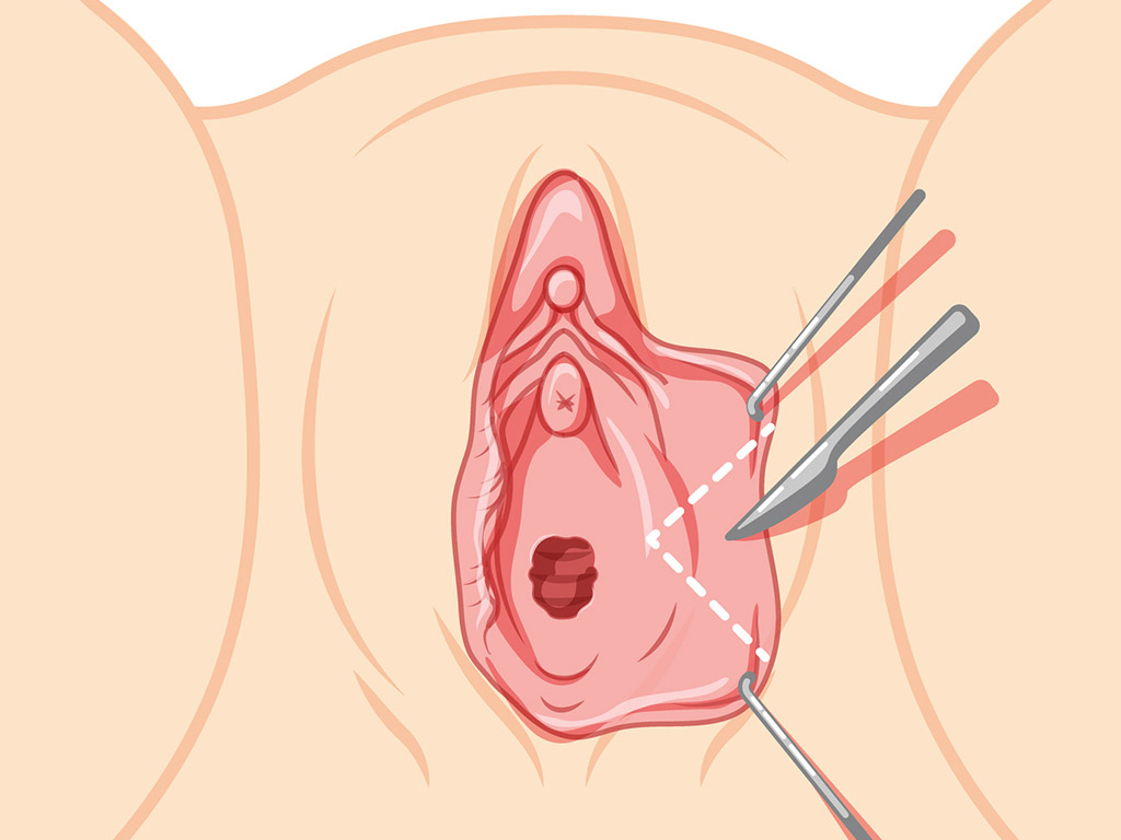 Tipos de técnica de cuña de revisión de labioplastia en Nueva York
