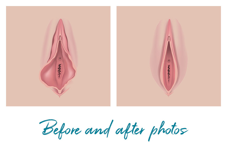 before and after vaginal reconstruction photos showing visible results