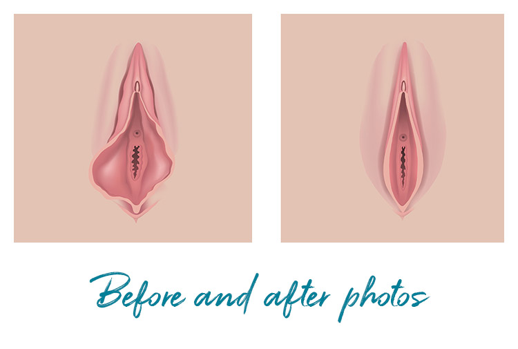 labiaplasty before and after photos in Queens