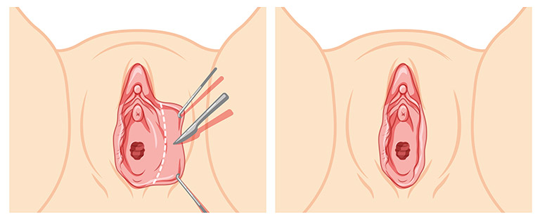 técnica de recorte en labioplastia