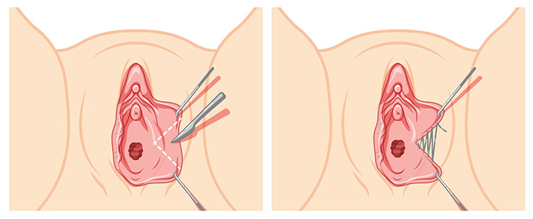técnica de cuña en la labioplastia